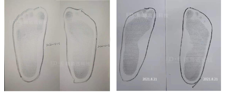 3d打印矯形鞋墊